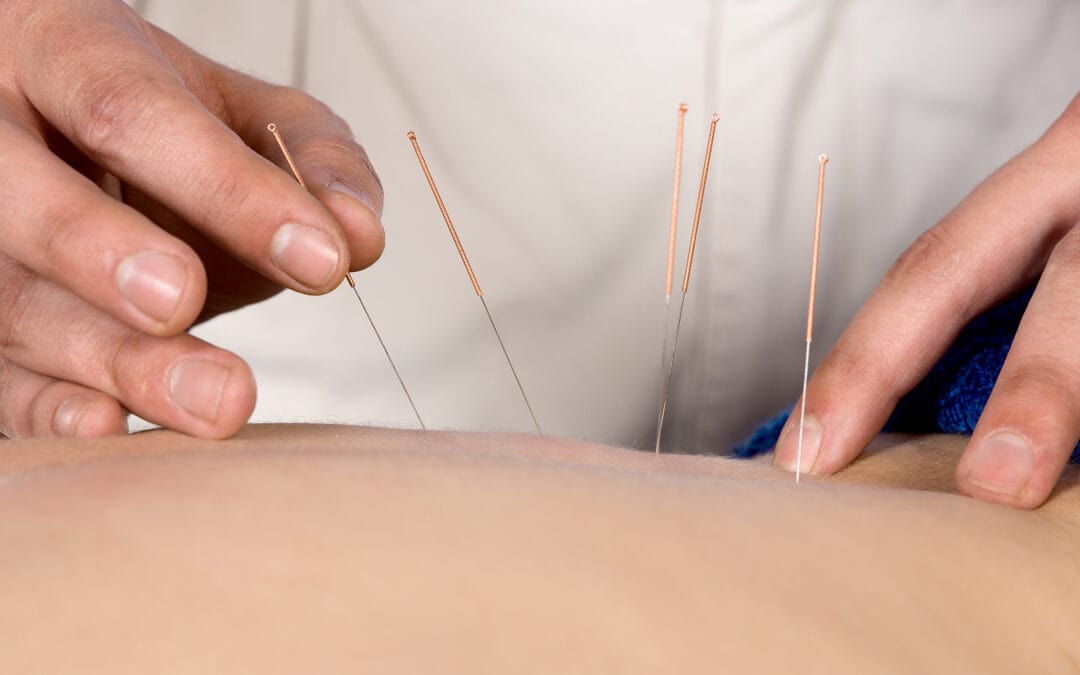 Gentle Support for Pregnancy: Acupuncture for Morning Sickness